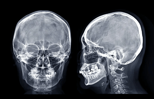 Radiografía de cráneo, 2 posiciones en Hospital Zambrano Hellion