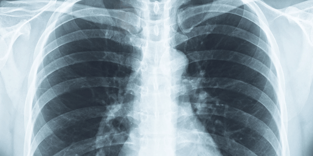 Radiografía de tórax, 1 posición en Hospital Zambrano Hellion