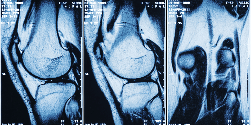 Resonancia magnética de rodilla simple en Hospital Zambrano Hellion