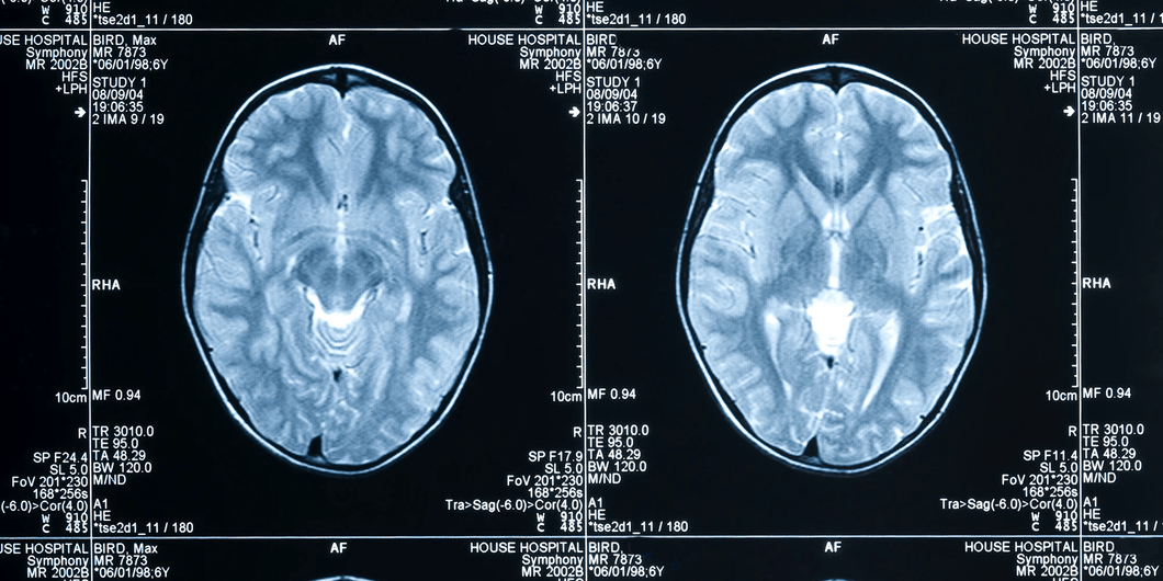 Tomografía de encéfalo simple en Hospital Zambrano Hellion