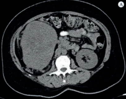 Tomografía urológico simple en Hospital Zambrano Hellion