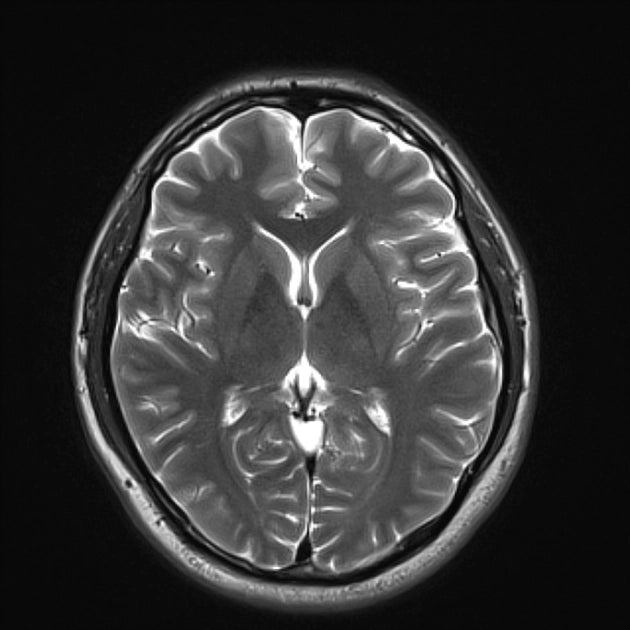 Resonancia magnética de cerebro simple en Hospital San José