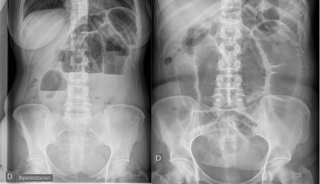Radiografía de abdomen, 2 posiciones en Hospital San José